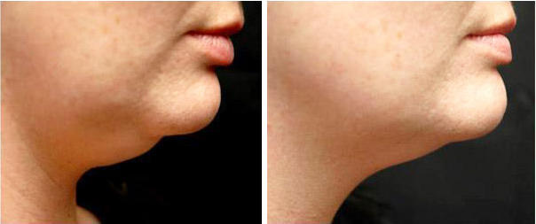 Before and After Pictures